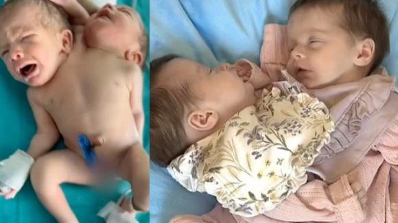 UK: le gemelle siamesi Annabelle ed Isabelle saranno separate il prossimo mese