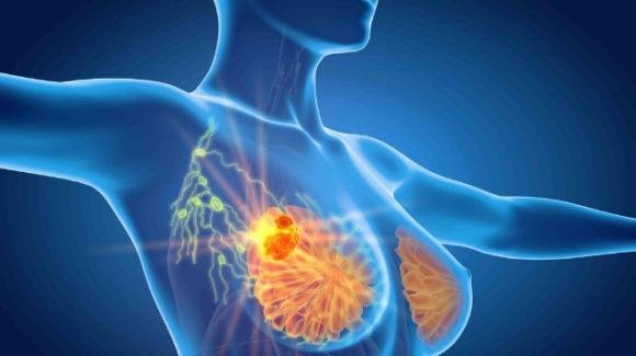 Cancro al seno, la nuova ‘chemioterapia intelligente’: risultati straordinari