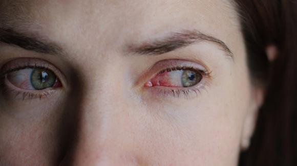 Nuovo virus causa febbre e occhi rossi: il racconto su TikTok