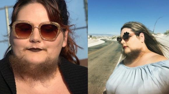 USA, 30enne barbuta racconta: "Mi radevo fino a 2 volte al giorno, ora mi sento più sexy che mai"
