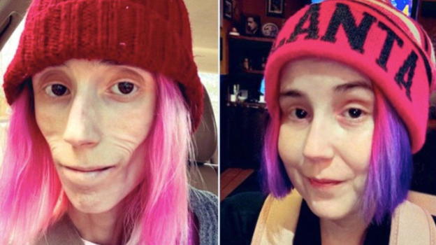 A un passo dalla morte per anoressia e bulimia: il racconto della sua rinascita