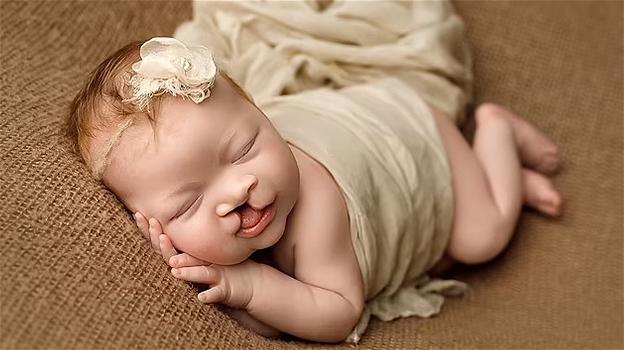 USA: neonata col labbro leporino diventa virale