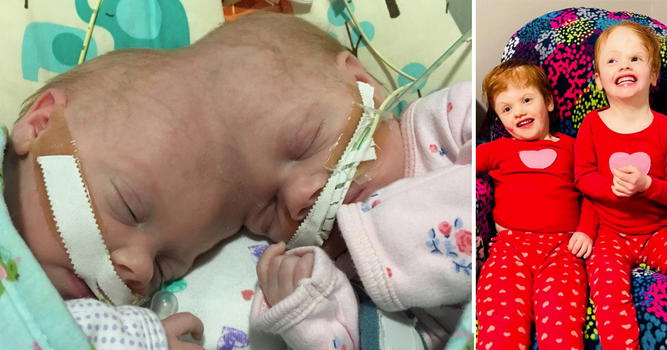 Gemelle siamesi separate terminano l’asilo, avevano il 2% di possibilità di sopravvivere