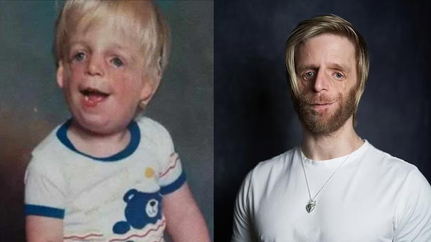 Jono Lancaster e la sua rara condizione genetica: "Abbandonato dai miei genitori appena mi videro"