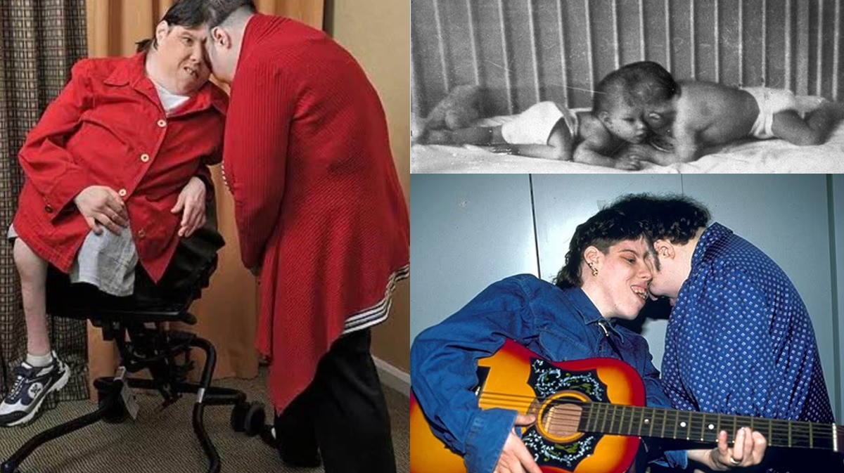 Addio a Lori e Schappell, i gemelli siamesi più vecchi al mondo