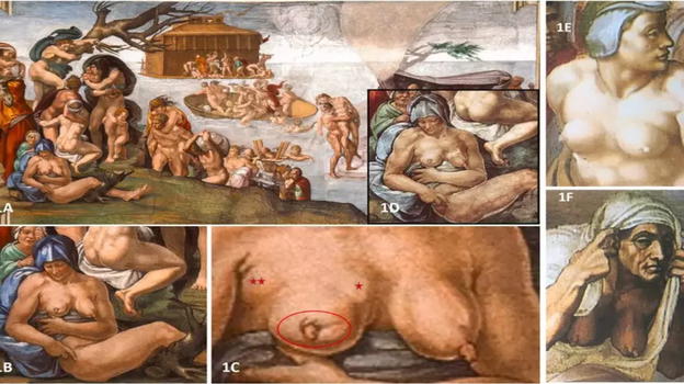 Michelangelo: nel Diluvio Universale, donna raffigurata con un carcinoma al seno?