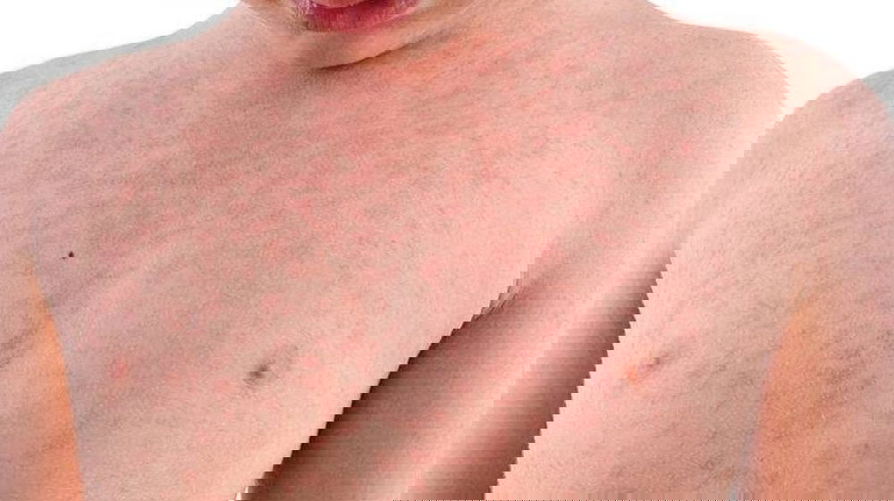 Allarme morbillo negli USA e in Europa con casi raddoppiati in Italia
