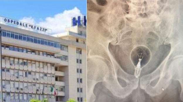 Lecce, 85enne ricoverato d’urgenza: lampadina rimossa dal retto all’ospedale “Fazzi”