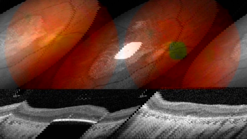 Dalla cecità alla lettura: il microchip che apre una nuova era per la vista