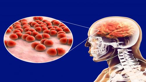 Meningite B, cresce l’attenzione sul possibile “super ceppo”: focolaio anomalo nel Regno Unito