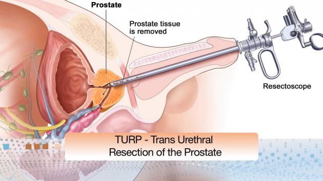 prostata gonfia cosa fare