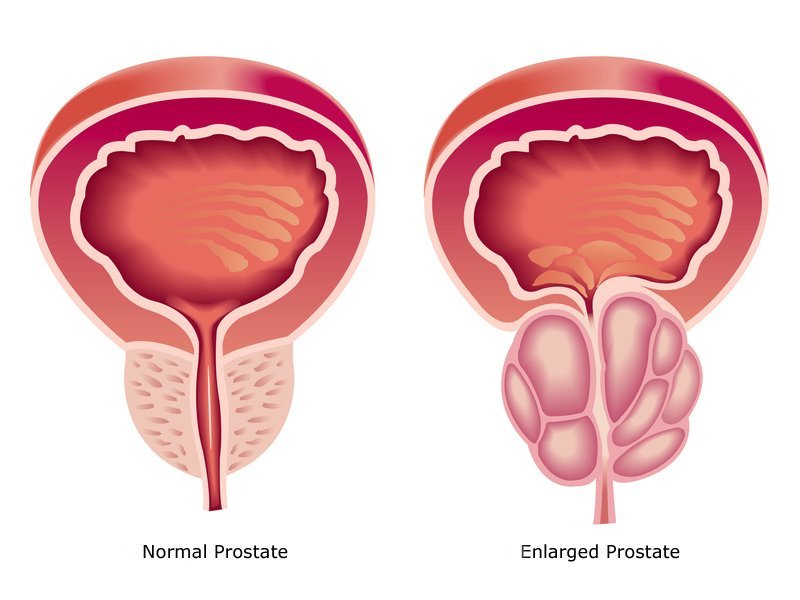 Prostata ingrossata: sintomi e rimedi dell'ipertrofia prostatica benigna