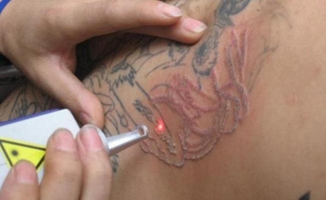 Rimozione tatuaggi con il laser: come funziona e costo