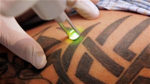 Rimozione tatuaggi con il laser: come funziona e costo