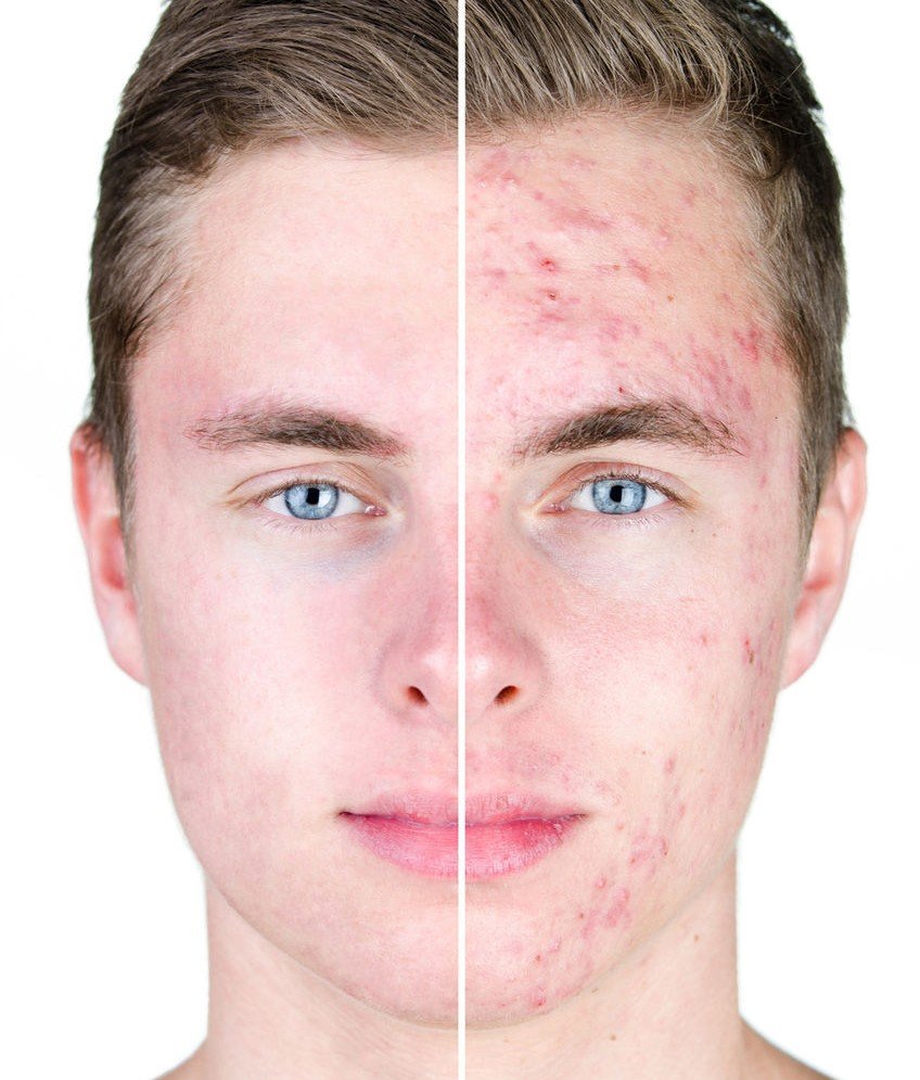 Cicatrici acne: ecco come eliminarle. Laser o rimedi naturali?