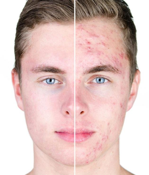 rimedi contro cicatrici acne