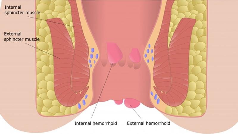 Le emorroidi possono essere interne o esterne