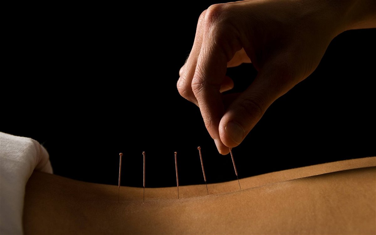 I cinesi, per curare la prostatite, usano l'agopuntura