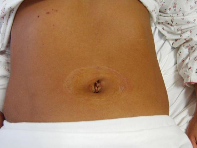 Ernia Ombelicale Chirurgo Dott Stefano Enrico Torino