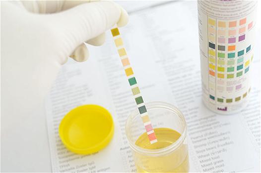 Escherichia coli nelle urine: cause, valori normali ed alcuni rimedi
