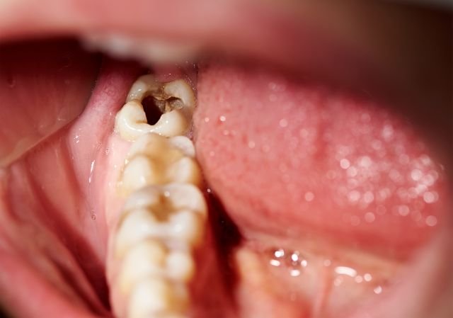 La carie è uno dei motivi principali che può portare alla devitalizzazione di un dente, ma non l'unica
