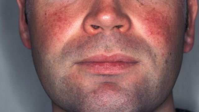 La rosacea, che porta alla comparsa di rossore e gonfiore sull'intero viso. Può essere causa della blefarite, una complicazione dell'orzaiolo