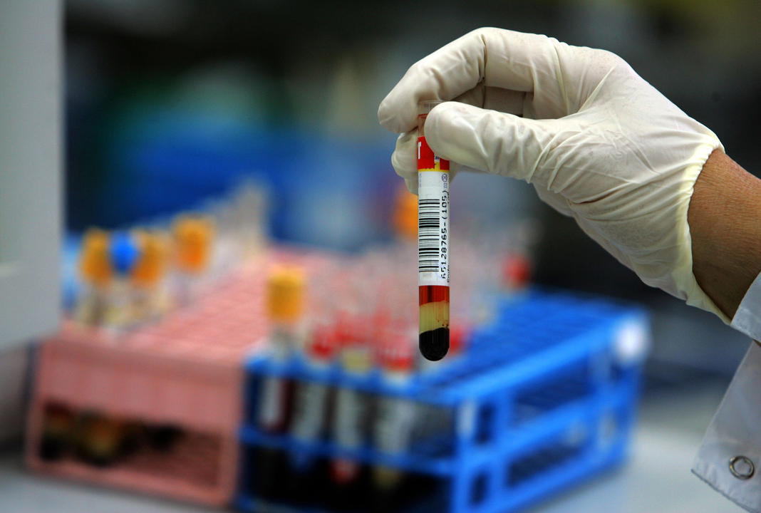 Creatininemia alta o bassa: cosa significa e valori normali