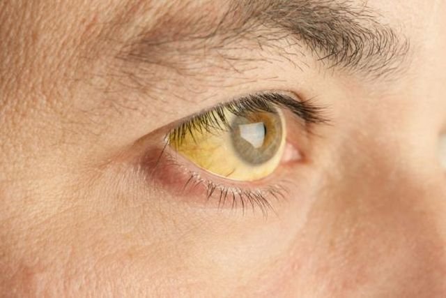 Gli occhi gialli, così come il colorito giallastro della pelle, sono sintomi tipici dell'ittero, una patologia legata al fegato 
