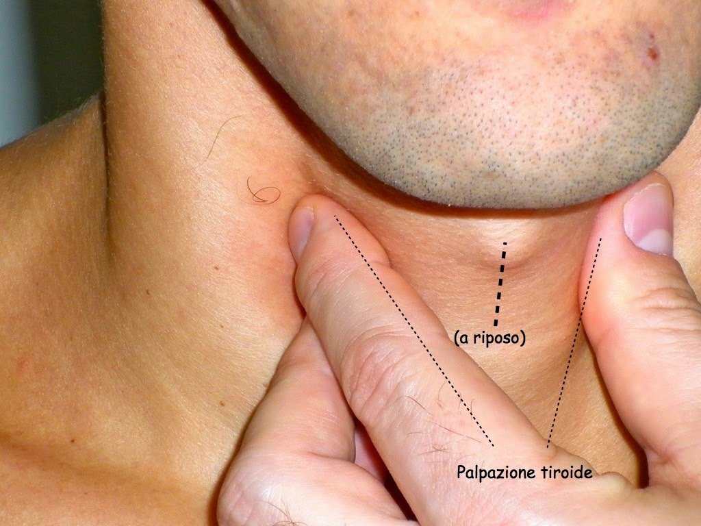 I linfonodi ingrossati del collo possono essere rilevati attraverso la semplice palpazione.