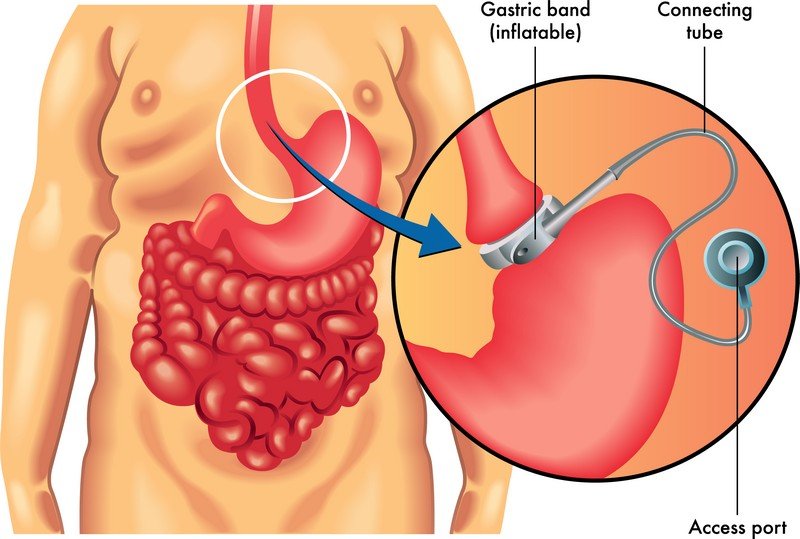 Schema illustrativo del bendaggio gastrico regolabile