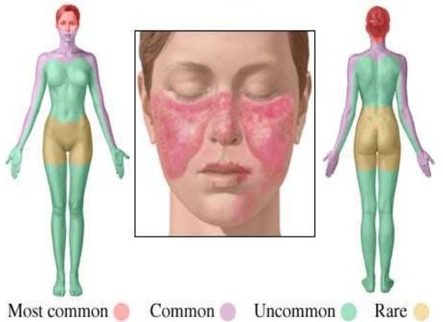 Lupus: quali sono i sintomi della malattia