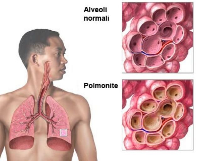 Polmonite: sintomi e terapia