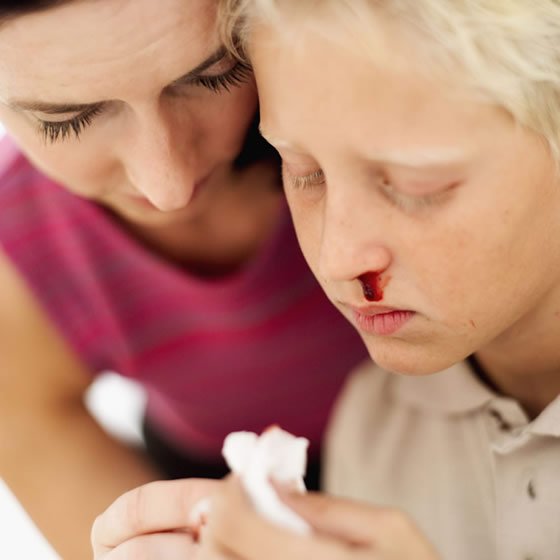 Sangue dal naso negli adulti: cause e rimedi efficaci