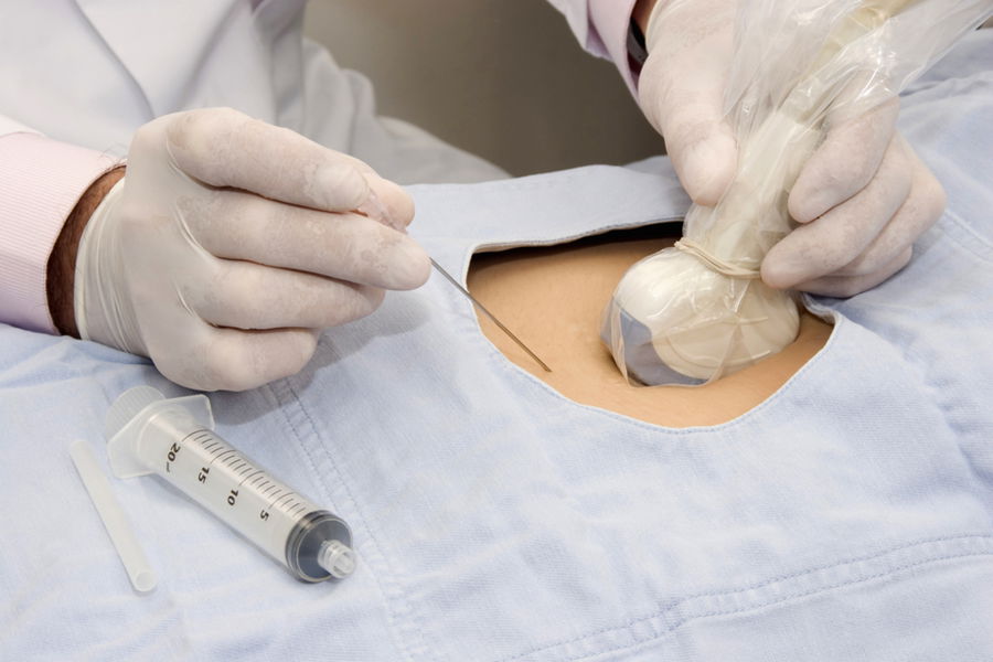 Quando fare l’amniocentesi