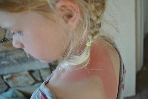Eritema solare nei bambini: sintomi e cure