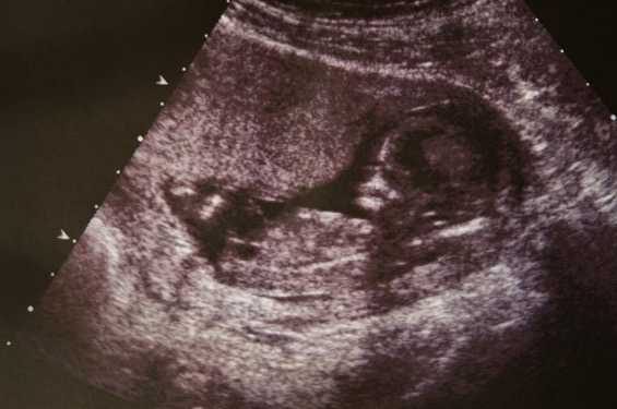 Donna si prepara al cesareo sapendo che il figlio morirà. Poi avviene il miracolo!