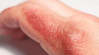 Bruciature: come provvedere velocemente per i segni