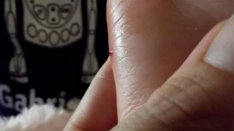 Come estrarre una scheggia dalla pelle in modo semplice