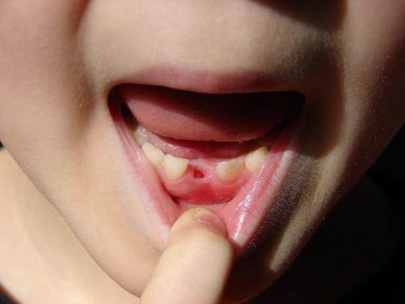 I medici avvertono: “Conservate i denti da latte dei vostri bambini, è importante”