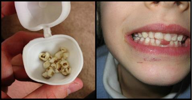 I medici avvertono: “Conservate i denti da latte dei vostri bambini, è importante”
