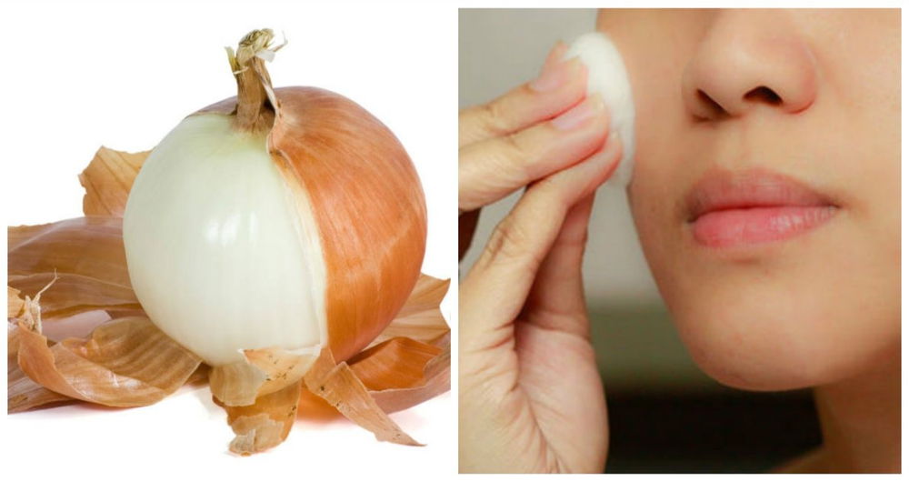 Cosparge il viso con il succo della cipolla. Non potrai più fare a meno di questo rimedio naturale