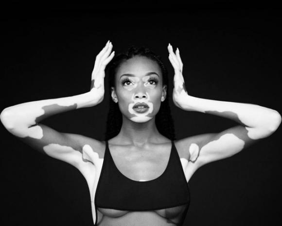 Tutto il mondo impazzisce per questa modella, ma cos’ha in faccia?
