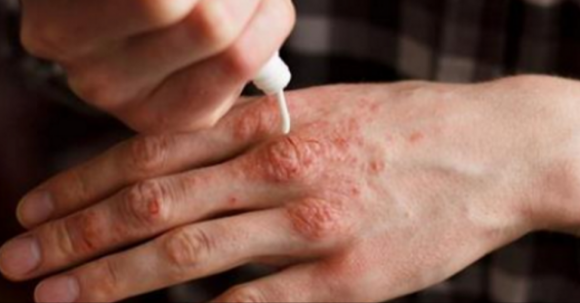 Ecco alcune creme naturali per curare la psoriasi