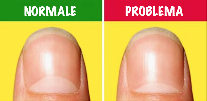 Questi problemi delle unghie possono dare indizi importante sulla nostra salute