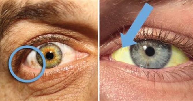 Queste 12 condizioni degli occhi possono indicare diverse patologie