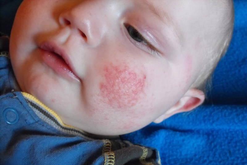 Quinta patologia nei bambini: sintomi iniziali, cura e contagio