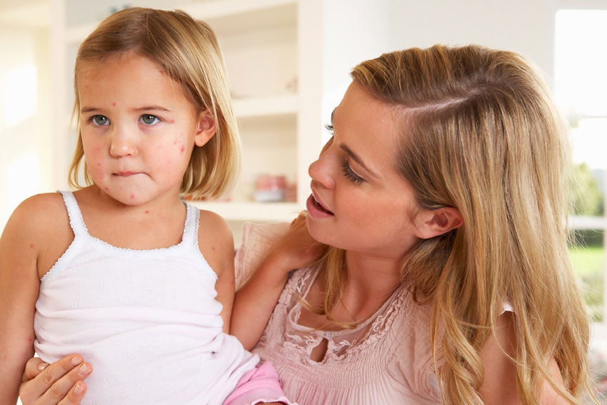Quarta malattia o scarlattinetta: sintomi nei bambini e cure