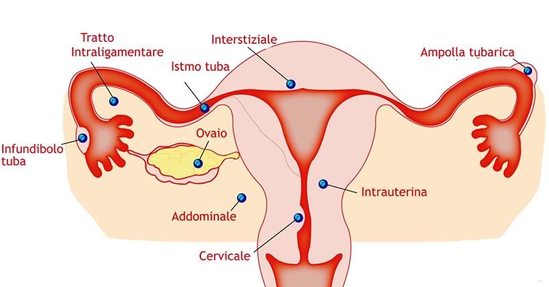 Nella gravidanza extrauterina l’embrione si annida fuori dall’utero