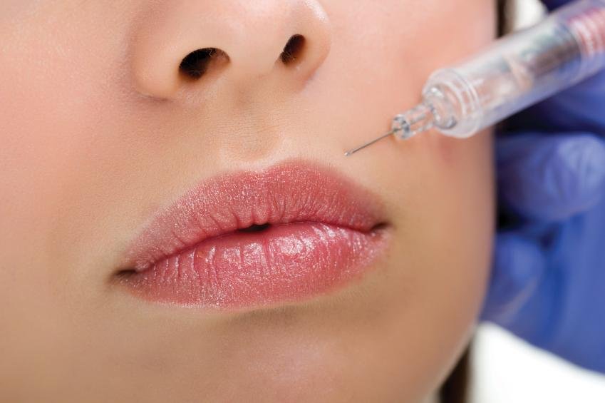 Le labbra gonfie possono essere anche conseguenza dell’applicazione di filler di sostanze riempitive 