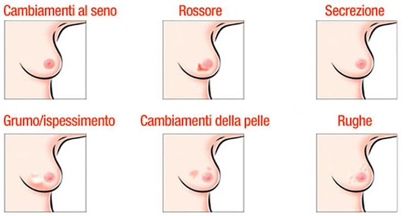La presenza di noduli al seno sono riconoscibili anche all'esterno